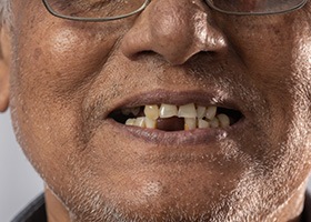 a dentist showing a patient a dental implant model