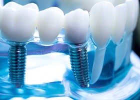 a dentist showing a patient a dental implant model