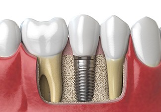 Digital illustration of a dental implant