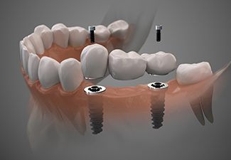 Digital illustration of an implant bridge