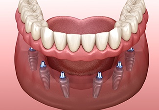 Digital illustration of an implant denture